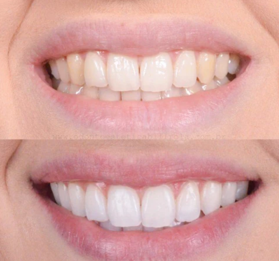 BrightSmile™ – Von Zahnkliniken inspirierte Zahnaufhellung für zu Hause