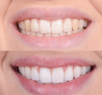 BrightSmile™ – Von Zahnkliniken inspirierte Zahnaufhellung für zu Hause