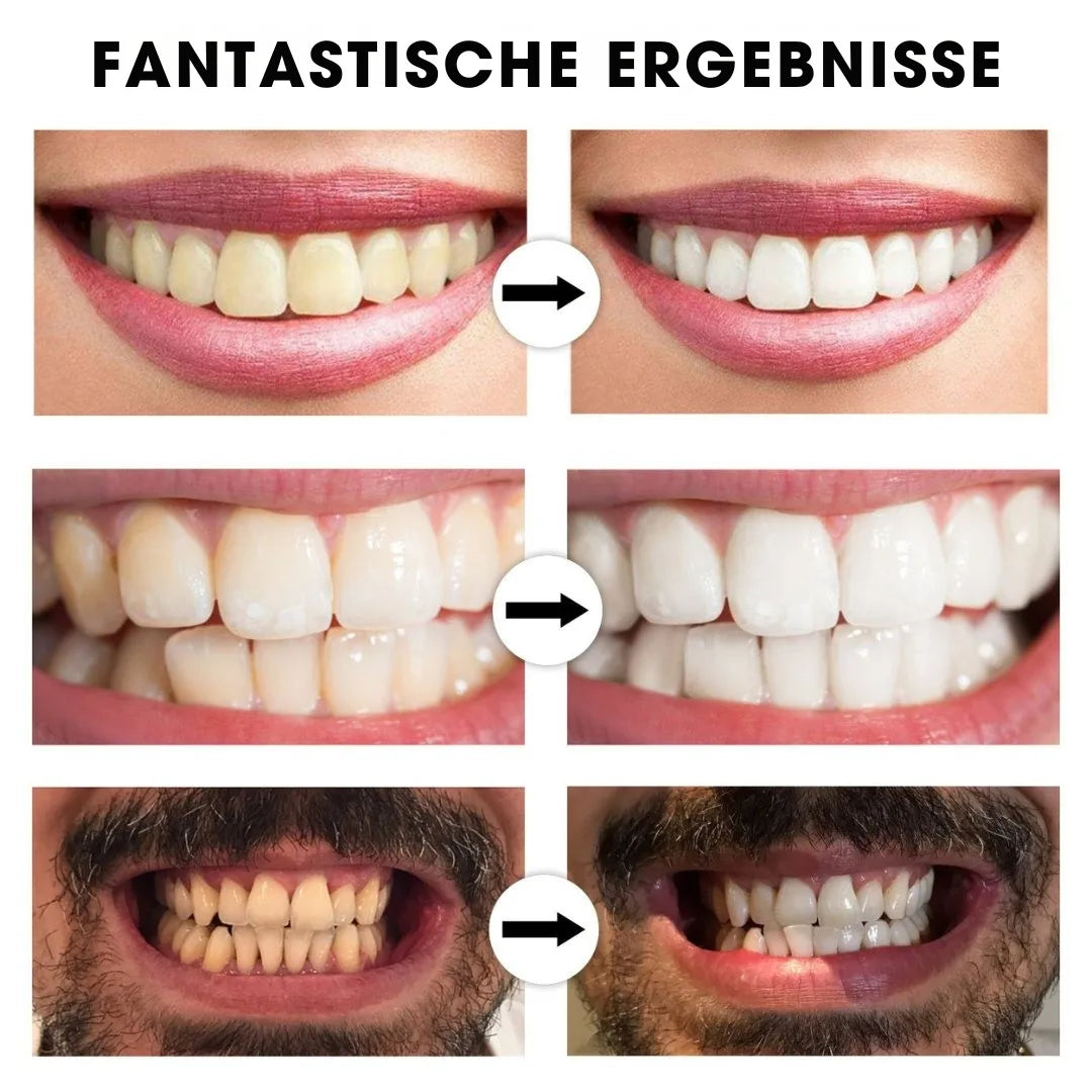 BrightSmile™ – Von Zahnkliniken inspirierte Zahnaufhellung für zu Hause